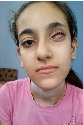 الرئيس يستجيب لمناشدة الطفلة اناغيم ويامر بتبني علالجها