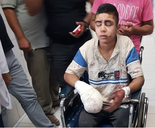 إصابة فتى بانفجار قنبلة أطلقها الاحتلال عليه في الخليل