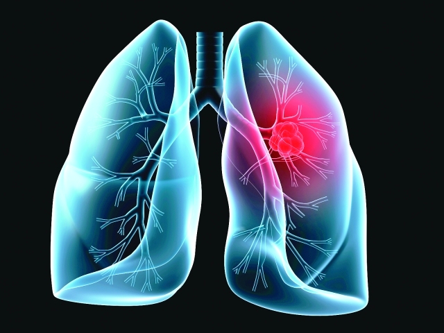 3 أسئلة.. الإجابة عليها بنعم تحتم عليك إجراء فحص سرطان الرئة