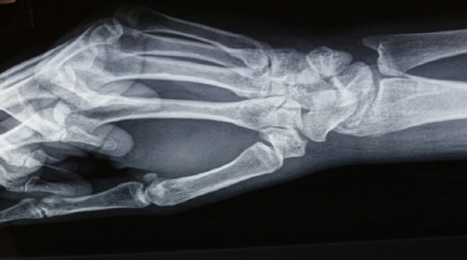 حالة طبية نادرة تسبب “اختفاء” عظام أصابع امرأة