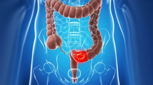 منها فقدان الوزن.. خمسة أعراض صامتة لسرطان القولون