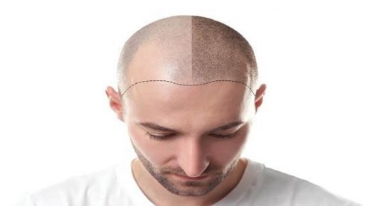 5 عوامل تؤدي إلى فشل زراعة الشعر