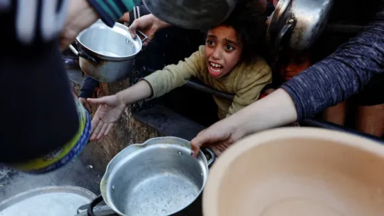 أطفال غزة سوء تغذية