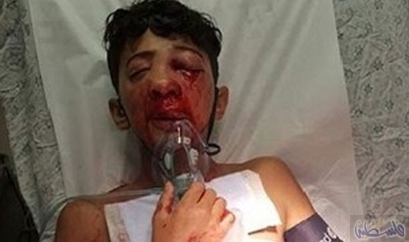 عيارات الاسفنج الاسرائيلية تسلب عين طفل فلسطيني
